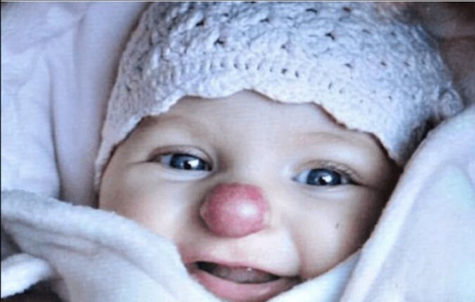 Jak po 3 latach wygląda dziewczynka, która urodziła się z „klaunowym” nosem